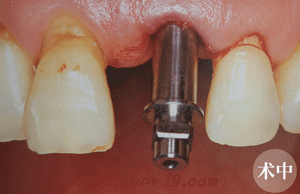 种植牙术中