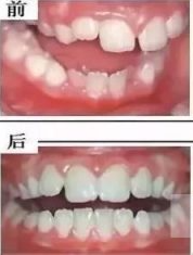 替牙期错颌畸形