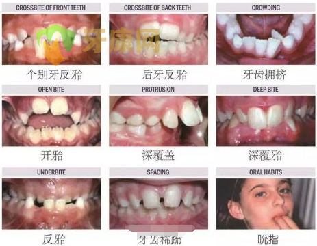 牙齿畸形图片