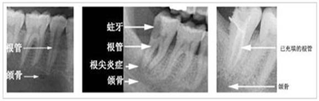 根管治疗