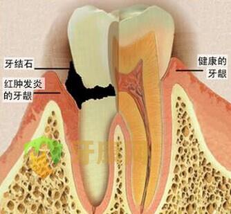 牙龈炎症状图片