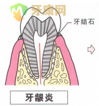 牙龈炎图片