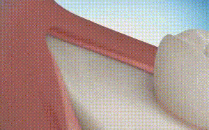 拔智齿后怎么护理