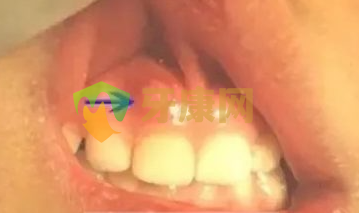 牙龈鼓牙包图片