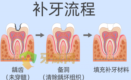 补牙流程图