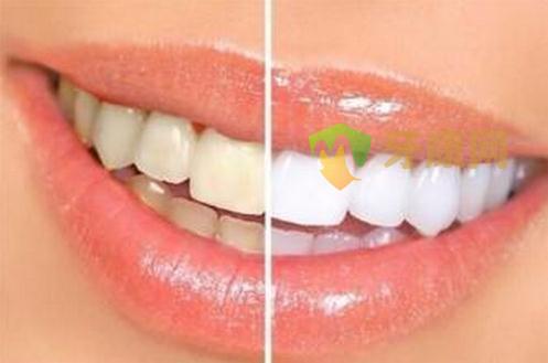 牙齿发黄怎么办？这几个方法告诉你！
