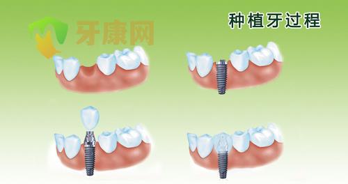 种植牙缺牙修复