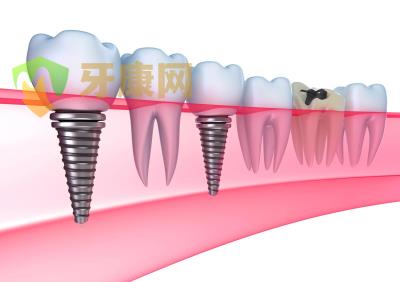 牙齿缺失做种植牙选择哪种方法好?