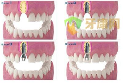 即刻种植牙和传统种植牙的区别
