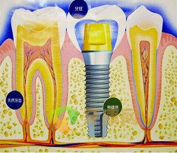 深圳种植牙医院