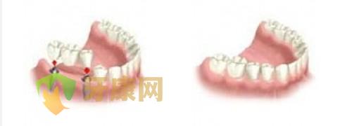 种植牙的价格较便宜是多少