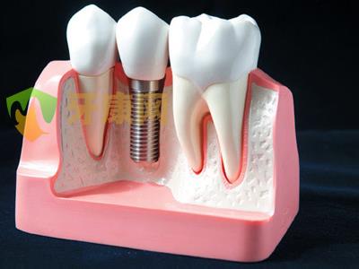 牙周病可以做种植牙吗