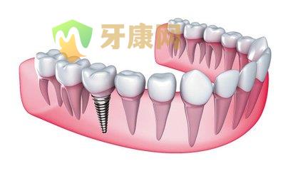 种植牙后多久能正常饮食