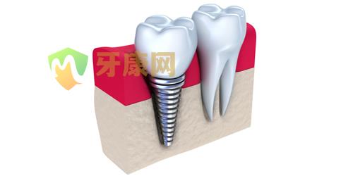 种植牙能使用多久