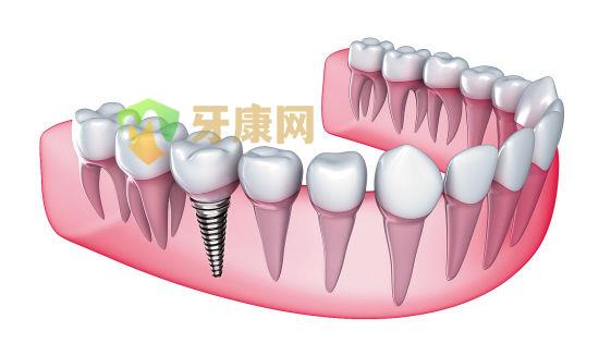 延长种植牙寿命需要注意什么