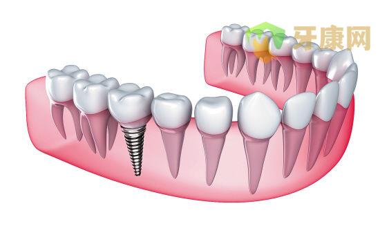 种植牙术后该如何护理