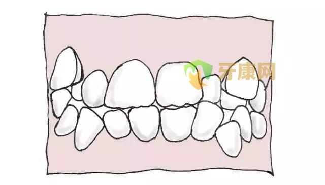 牙齿拥挤