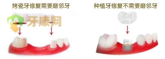 牙康网口腔医院烤瓷牙和种植牙的区别