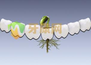 有牙周炎可以做种植牙