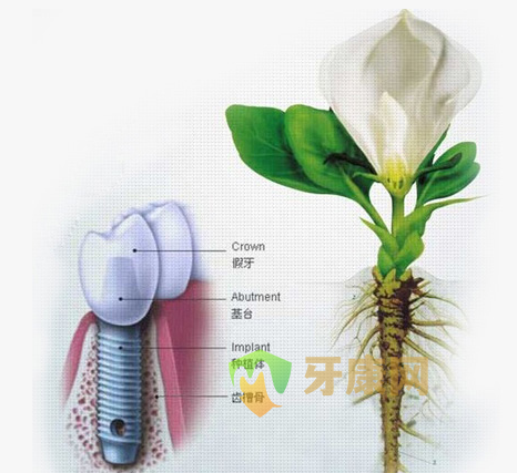 美国3i纳米种植牙