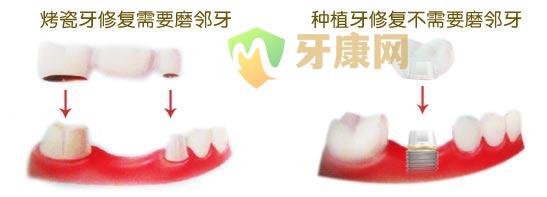  补牙、镶牙、种牙有什么区别?