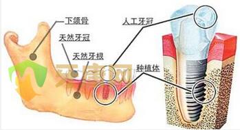 种植牙是怎么种的？（种植牙的详细步骤）