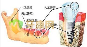 种植牙为什么要拍全景x光片？