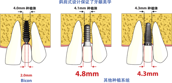 美国Bicon种植牙的适合哪些人？