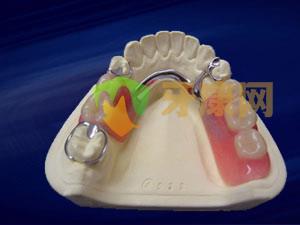 安装隐形义齿影响邻牙吗？