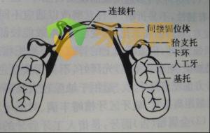 活动义齿哪种好？