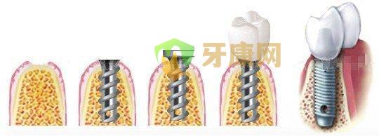 种植牙一般要去医院几次才能做好?