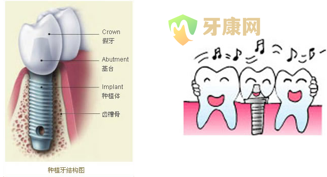 种植牙由几部分组成？