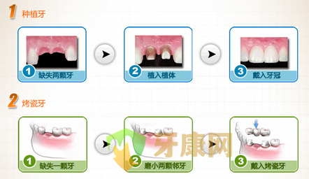 门牙缺失做全瓷牙好还是种植牙好？