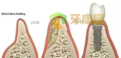 植牙补骨是怎么样做的？