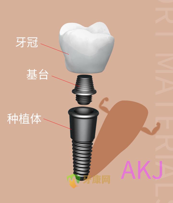 种植牙结构