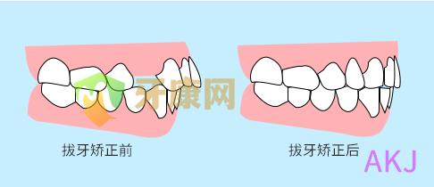 拔牙矫正