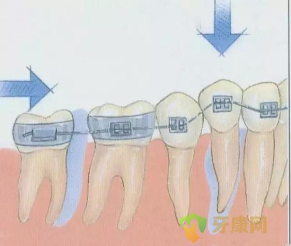 牙齿矫正需要注意些什么？