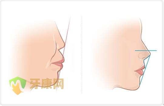 骨性龅牙矫正手术贵不贵