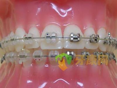 牙齿矫正失败可能会出现哪些后遗症