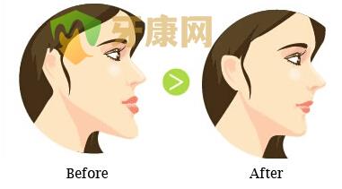 地包天矫正的方法