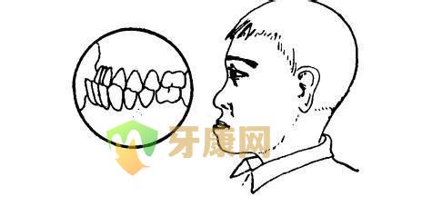哪些口腔习惯会导致地包天