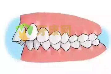 如何判断骨性龅牙和牙性龅牙