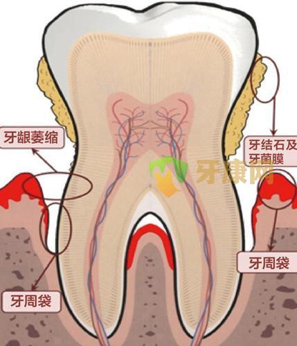 为啥牙缝越来越大,缝变大怎么办