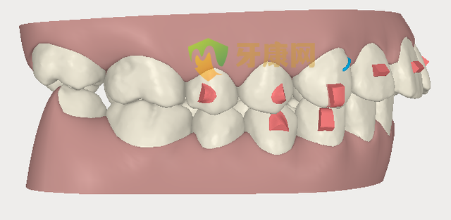 牙康网口腔医院龅牙矫正