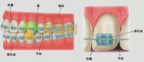 深圳牙康网金属托槽