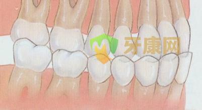 深圳牙康网口腔医院地包天示意图