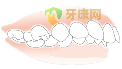 深圳牙齿前突的原因