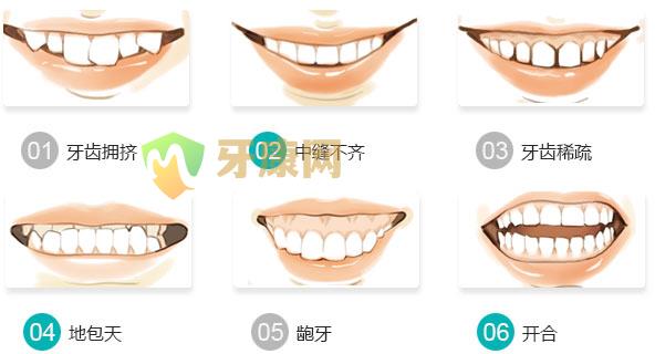 矫正和烤瓷牙哪个更好