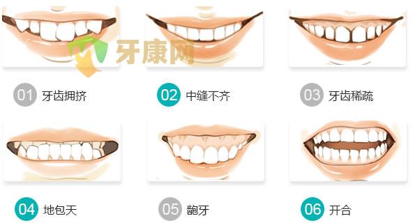 牙齿畸形矫正一般要多少钱？