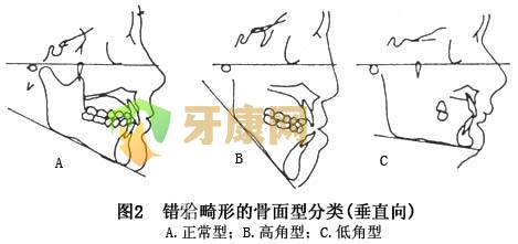 深覆合必须要手术矫正吗？